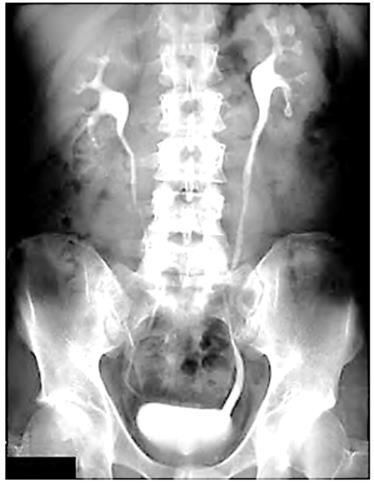 Imagem radiográfica contrastada do sistema urinário usada na questão 26.