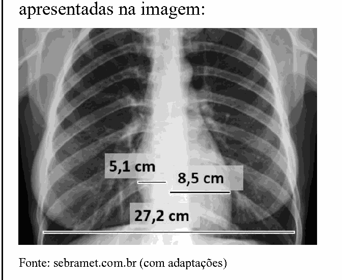 Radiografia de tórax com medidas do índice cardiotorácico