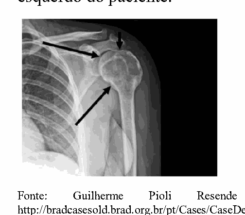 Radiografia do ombro esquerdo