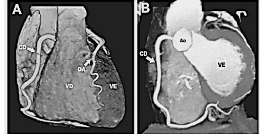 Angiotomografia coronariana com ventrículos direito e esquerdo identificados.